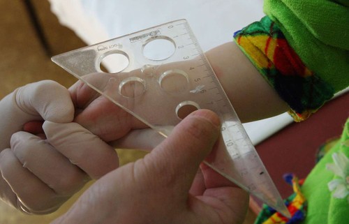 В Ялте регистрируют случаи туберкулёза среди детей