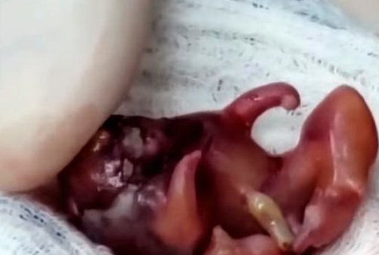 В Колумбии женщина родила дочь с близнецом-паразитом внутри 