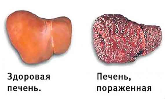 Гепатит в Севастополе становится фатальным диагнозом
