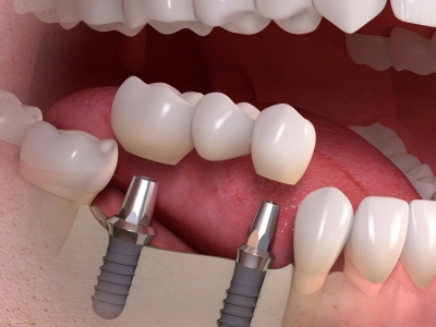 Где качественно и надежно сделать протезирование зубов?