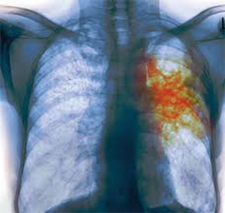 В Севастополе будут картографировать туберкулез
